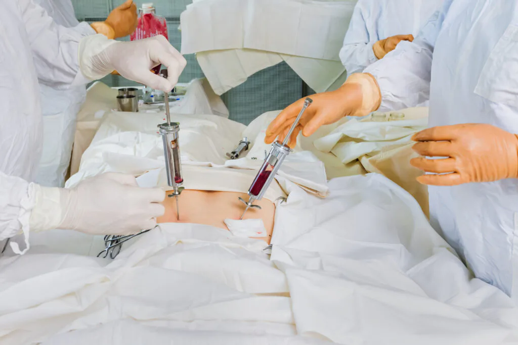 Imagem 2 de Transplante de Medula Óssea
