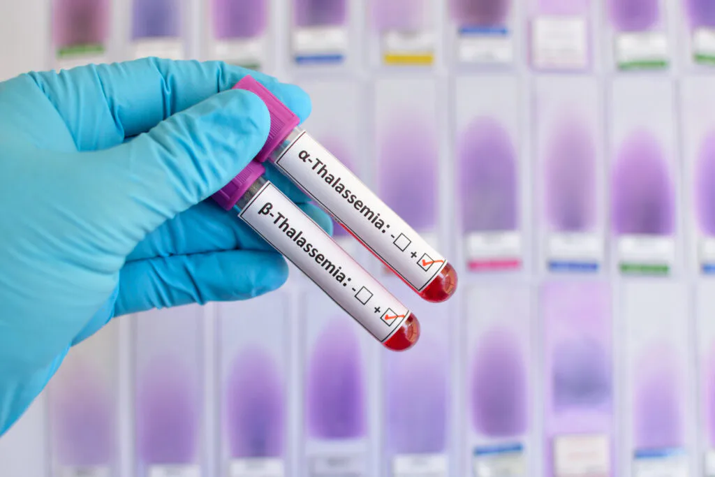 Imagem 2 de Os tipos de Talassemia