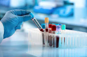 Imagem 3 de Talassemia Maior
