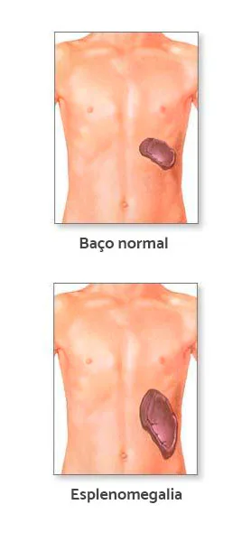 Imagem 3 de Retirar ou não o baço?